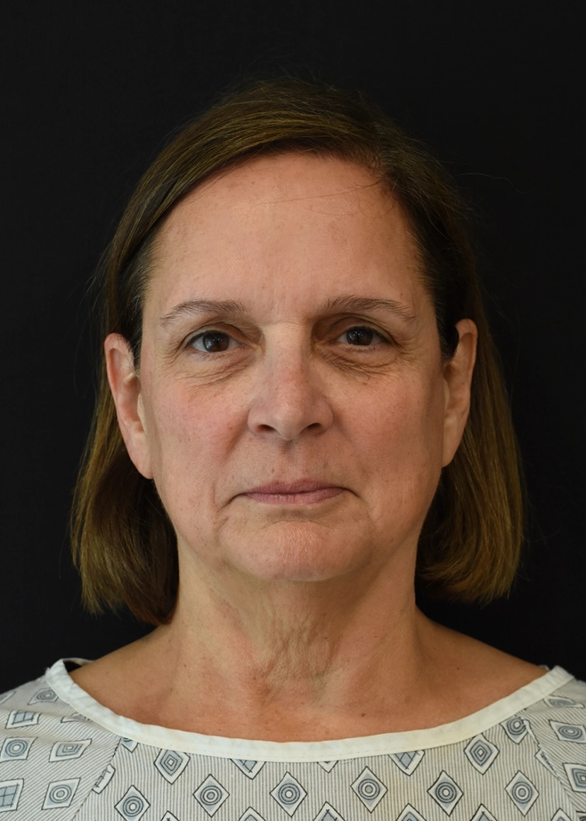 Extended Deep Plane Facelift Patient 6 Set 1 Before